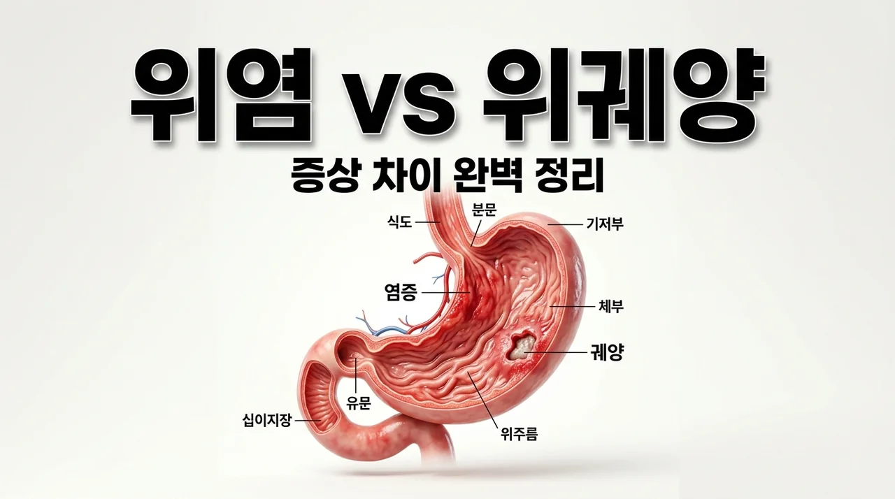 위염 위궤양 증상 차이, 헷갈리면 위험한 5가지 핵심 포인트